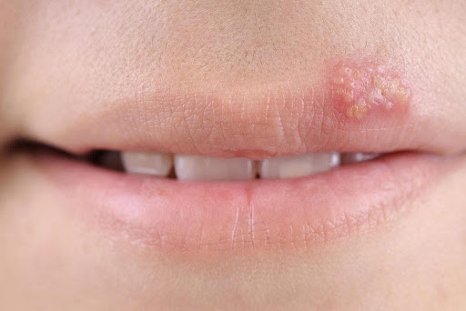 Treat Cold Sores with Light Therapy: Healing of Cold Sores